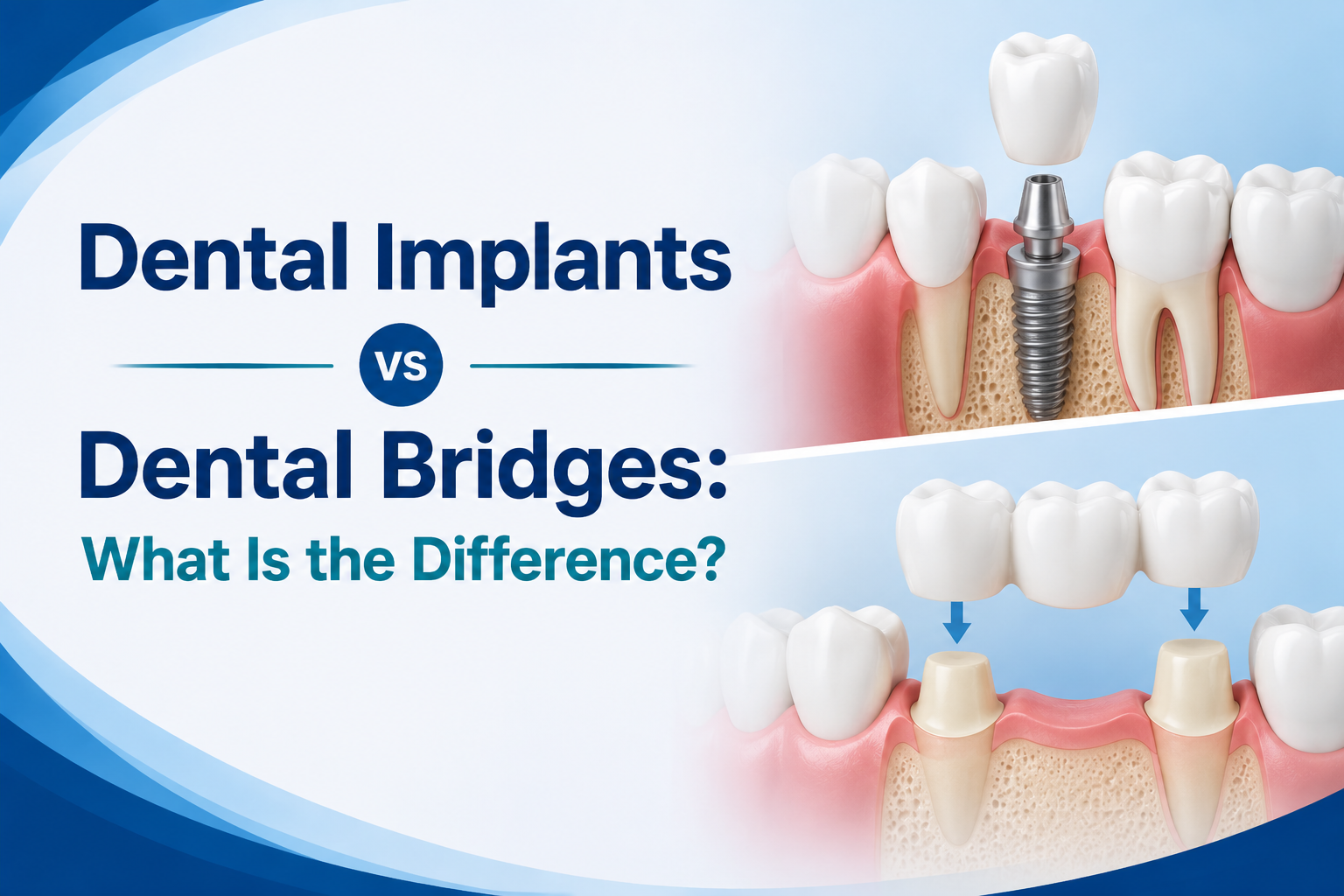 Dental Implants vs Dental Bridges What Is the Difference
