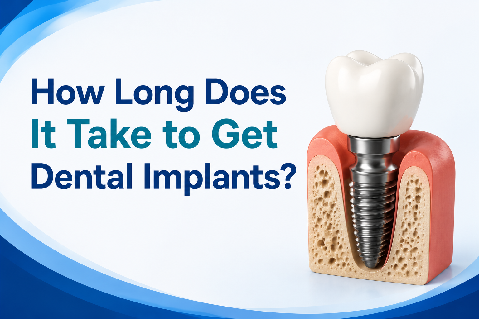 How Long Does It Take to Get Dental Implants