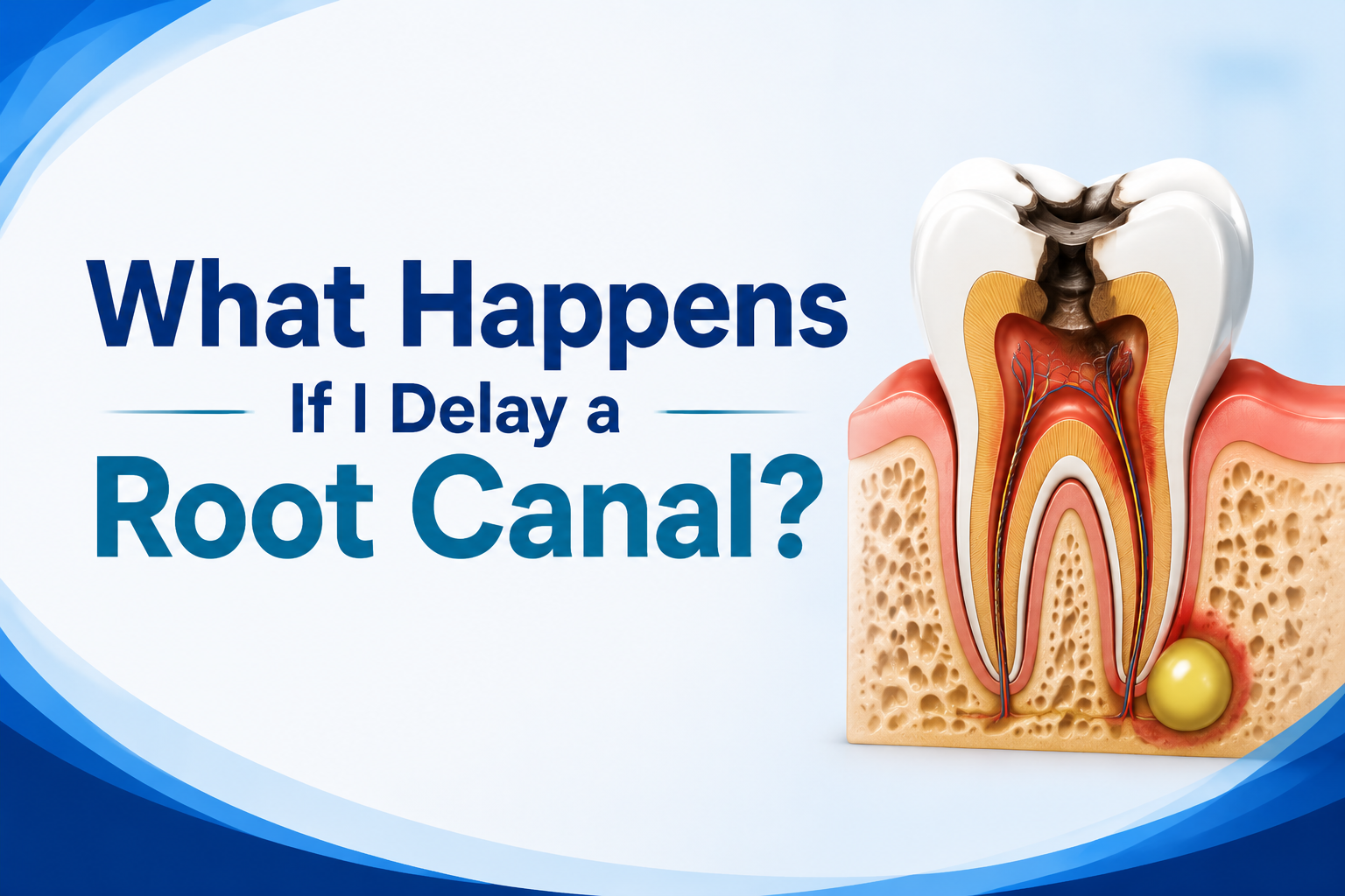 What Happens If I Delay a Root Canal