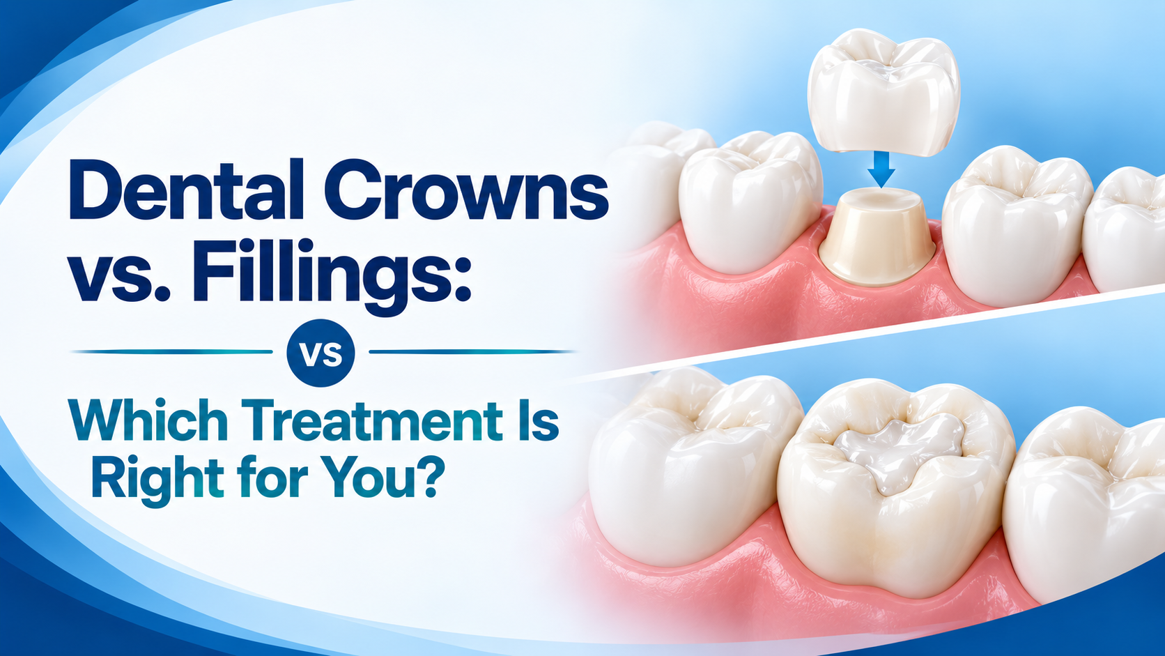 Dental Crowns vs. Fillings