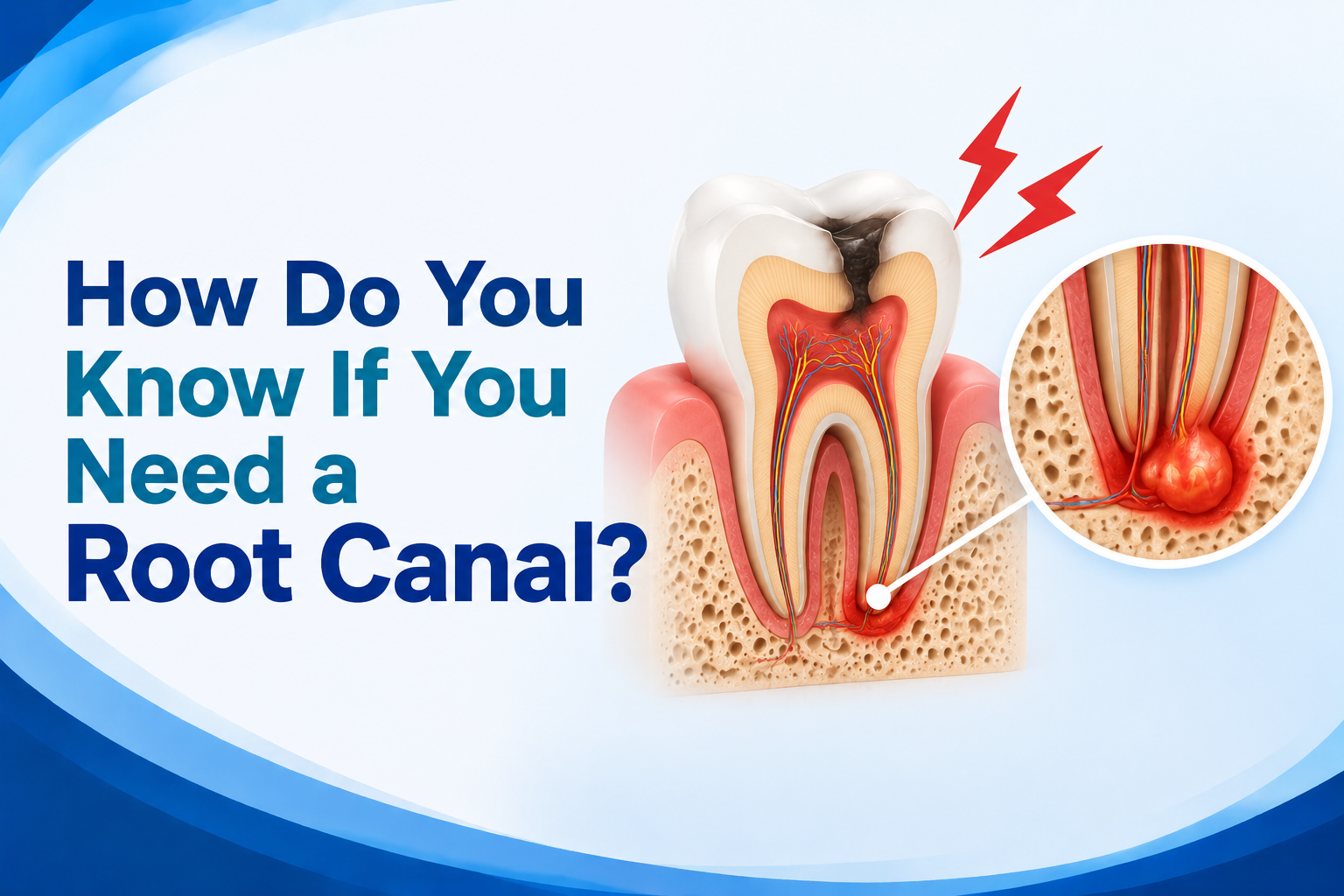 How Do You Know If You Need a Root Canal