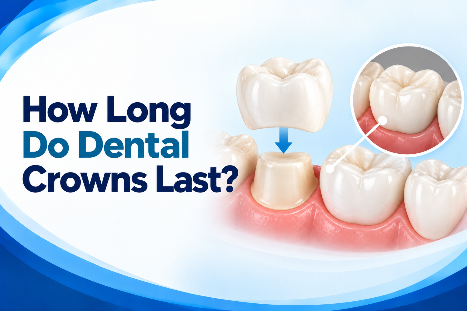 How Long Do Dental Crowns Last