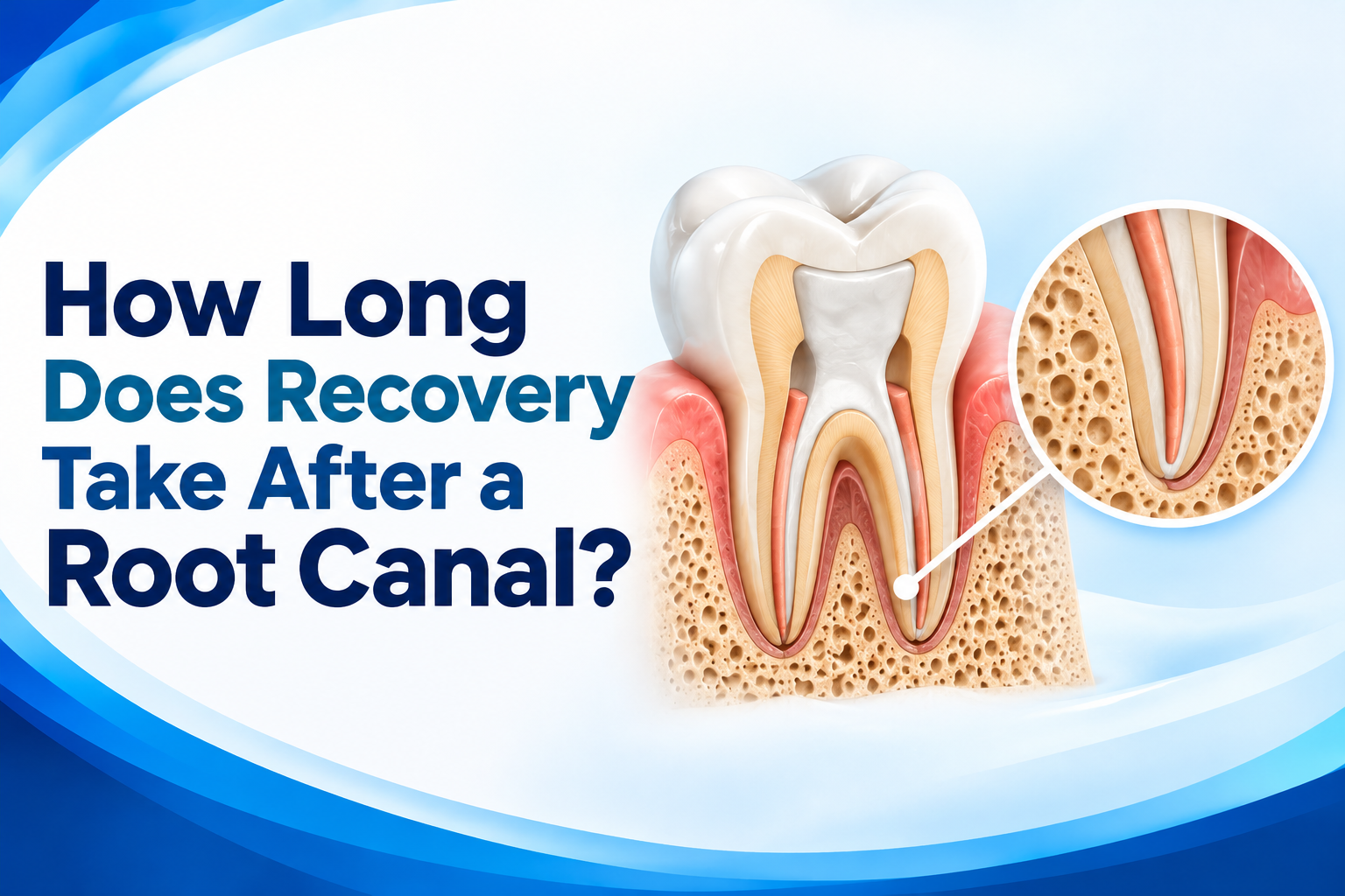 How Long Does Recovery Take After a Root Canal