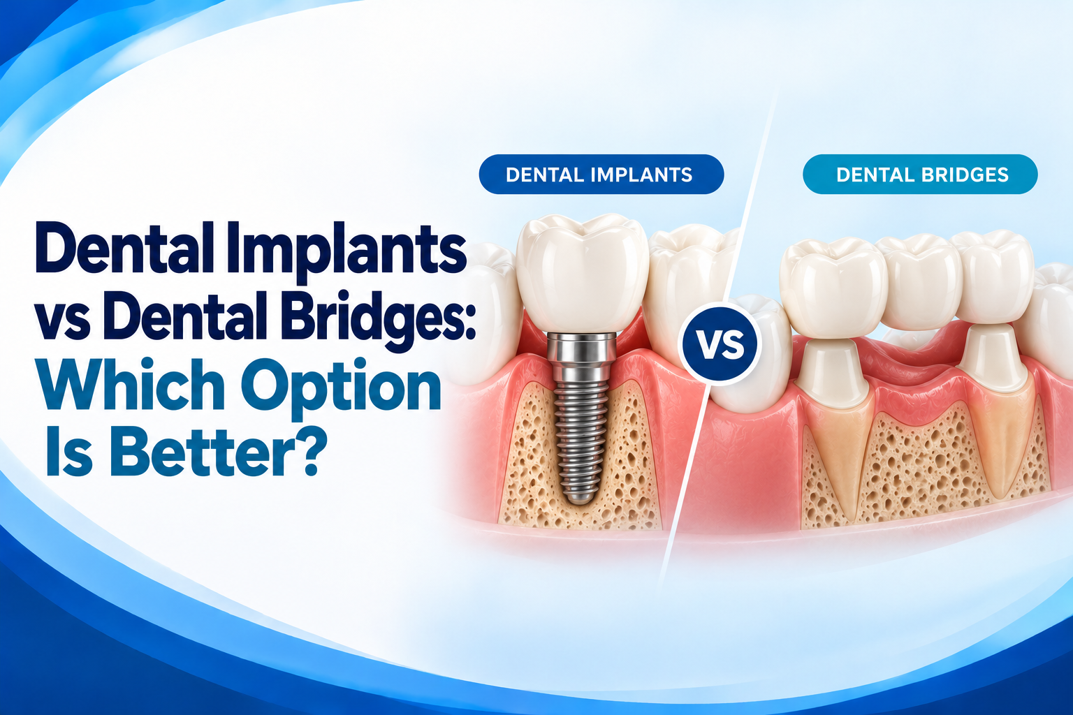Dental Implants vs Dental Bridges
